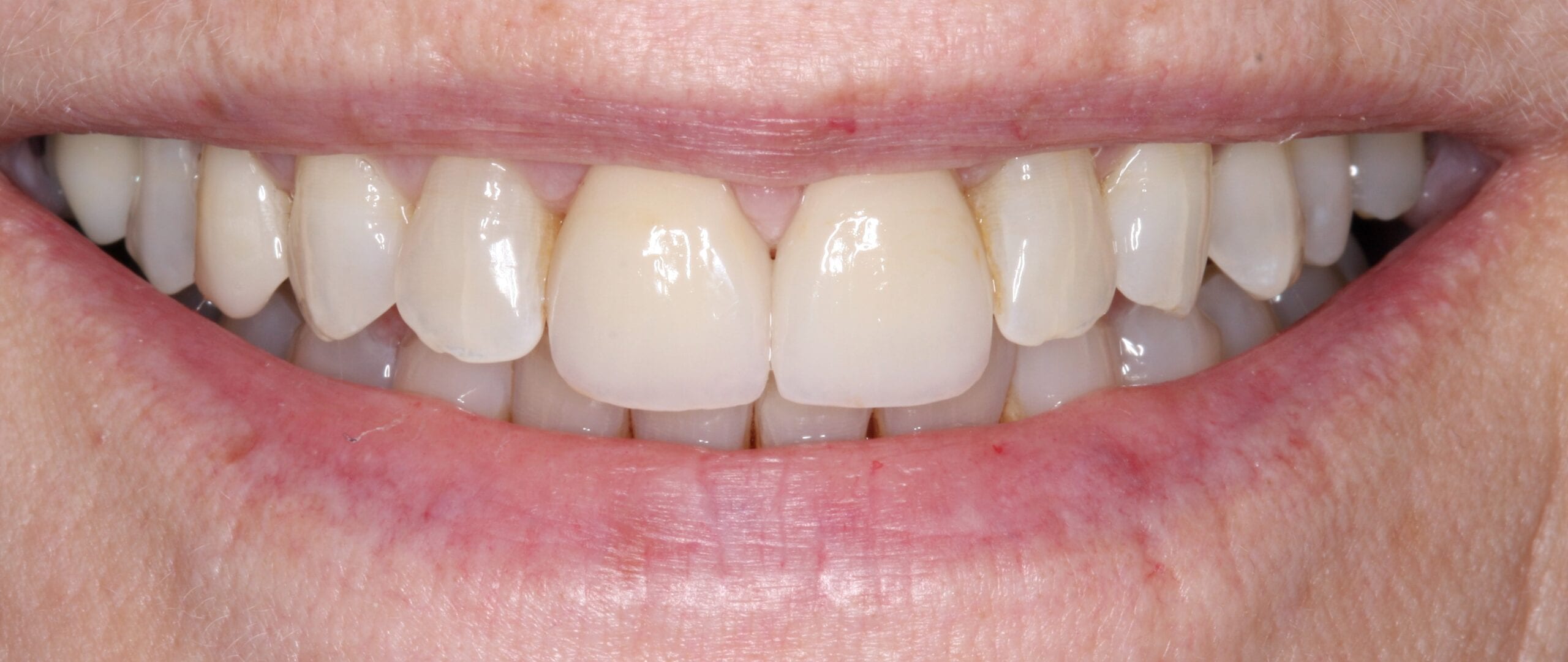 After smile