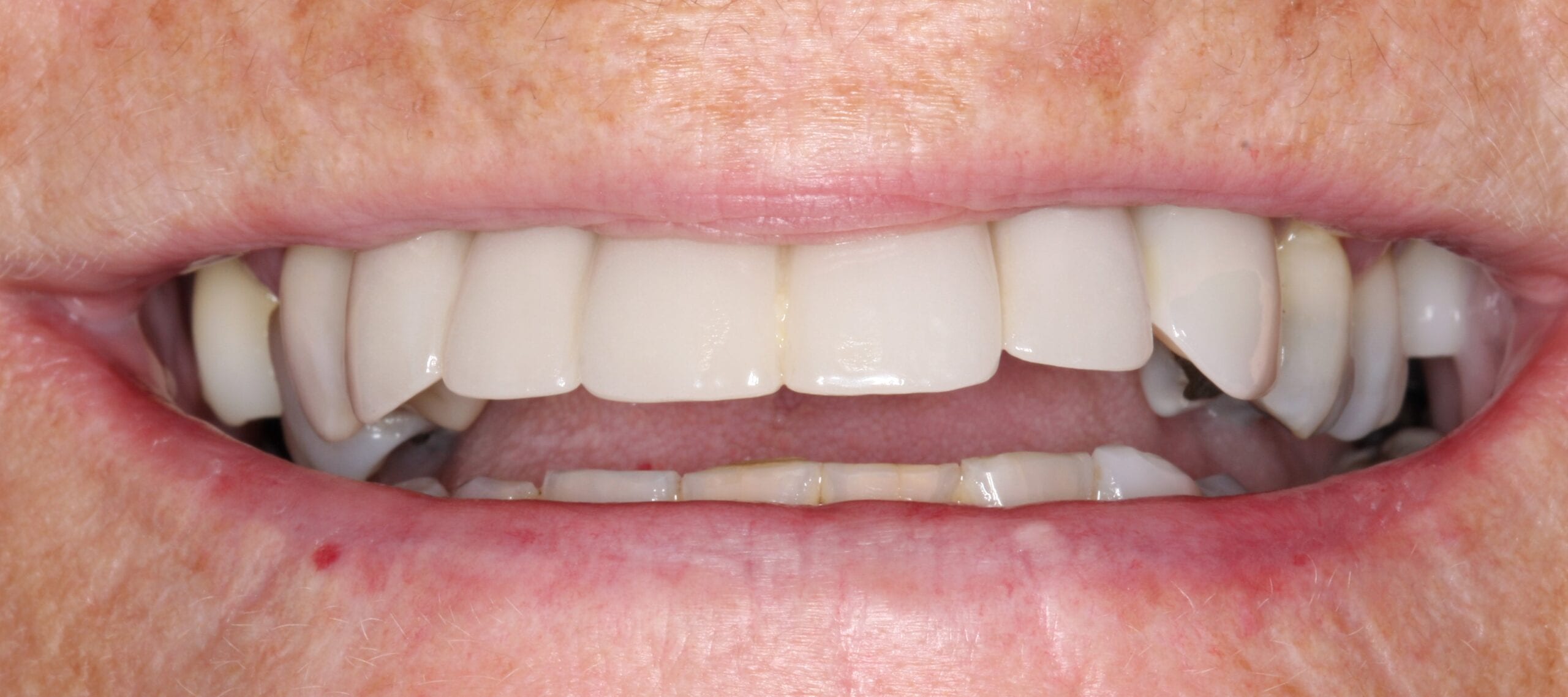 After smile