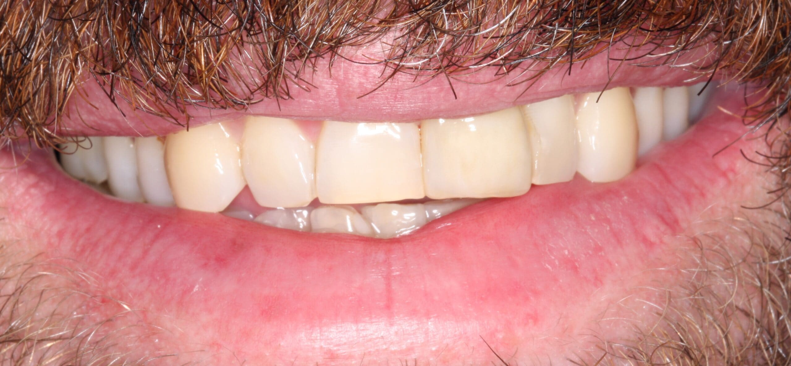 After image of a crown with a natural color since he has gotten older.