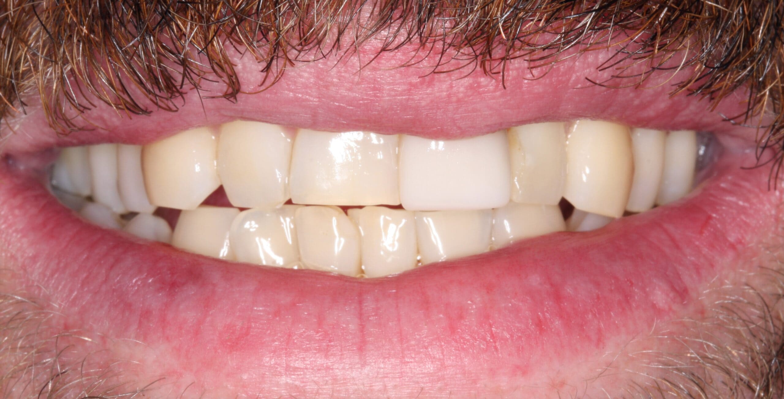 This patient needed to change his existing crown to a more natural color since he has gotten older.