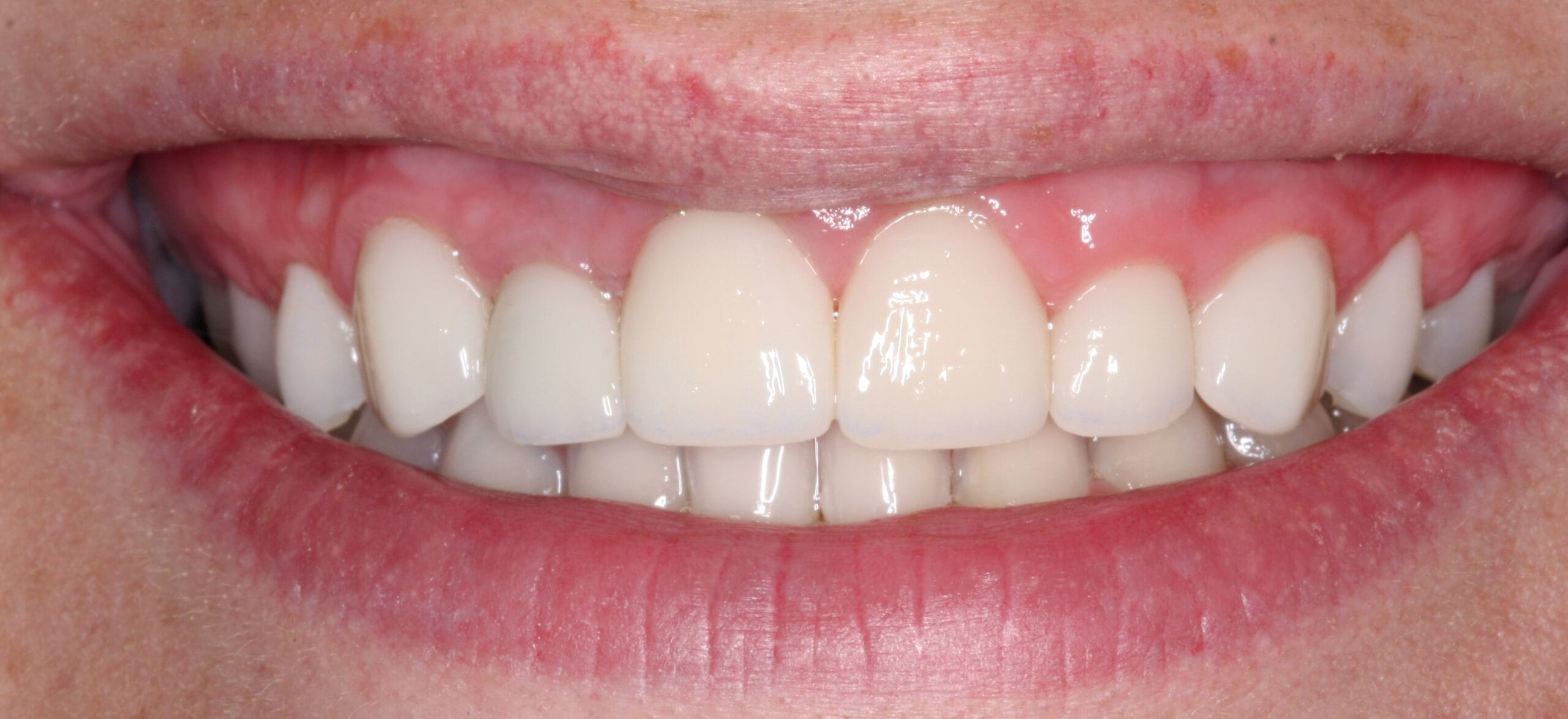 Dental crown patient after surgery smile.