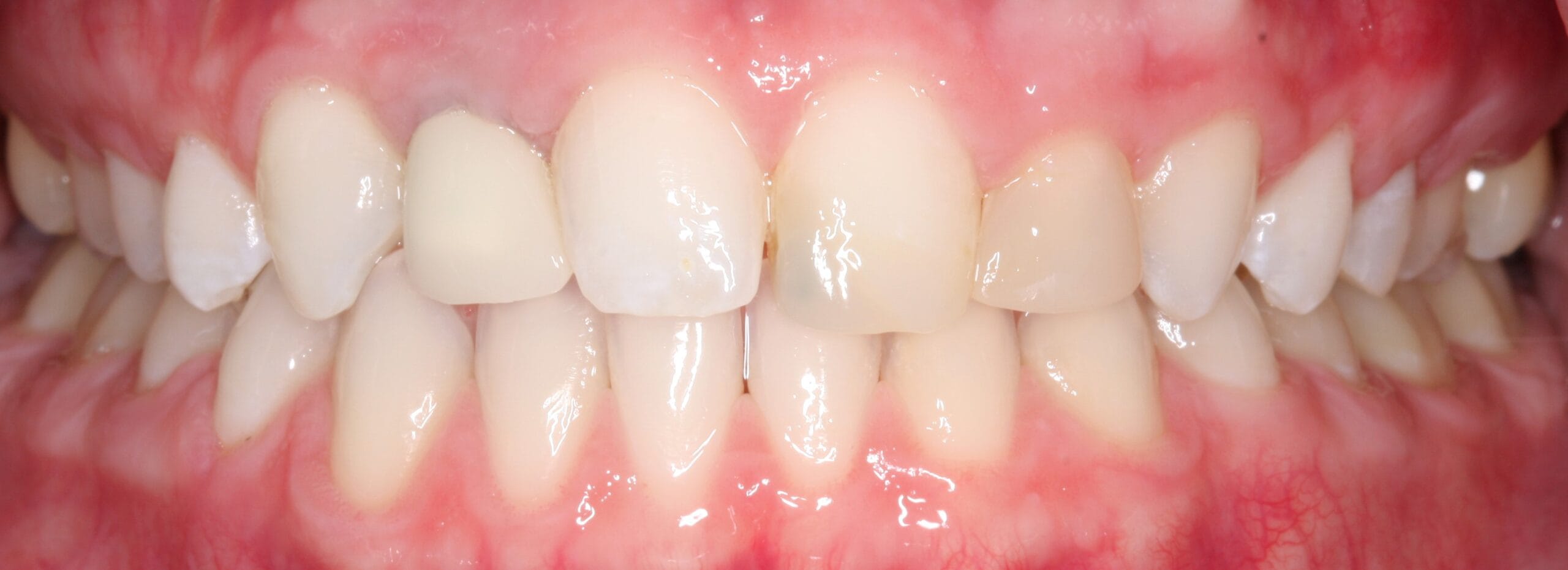 Dental crown patient before smile retracted view.