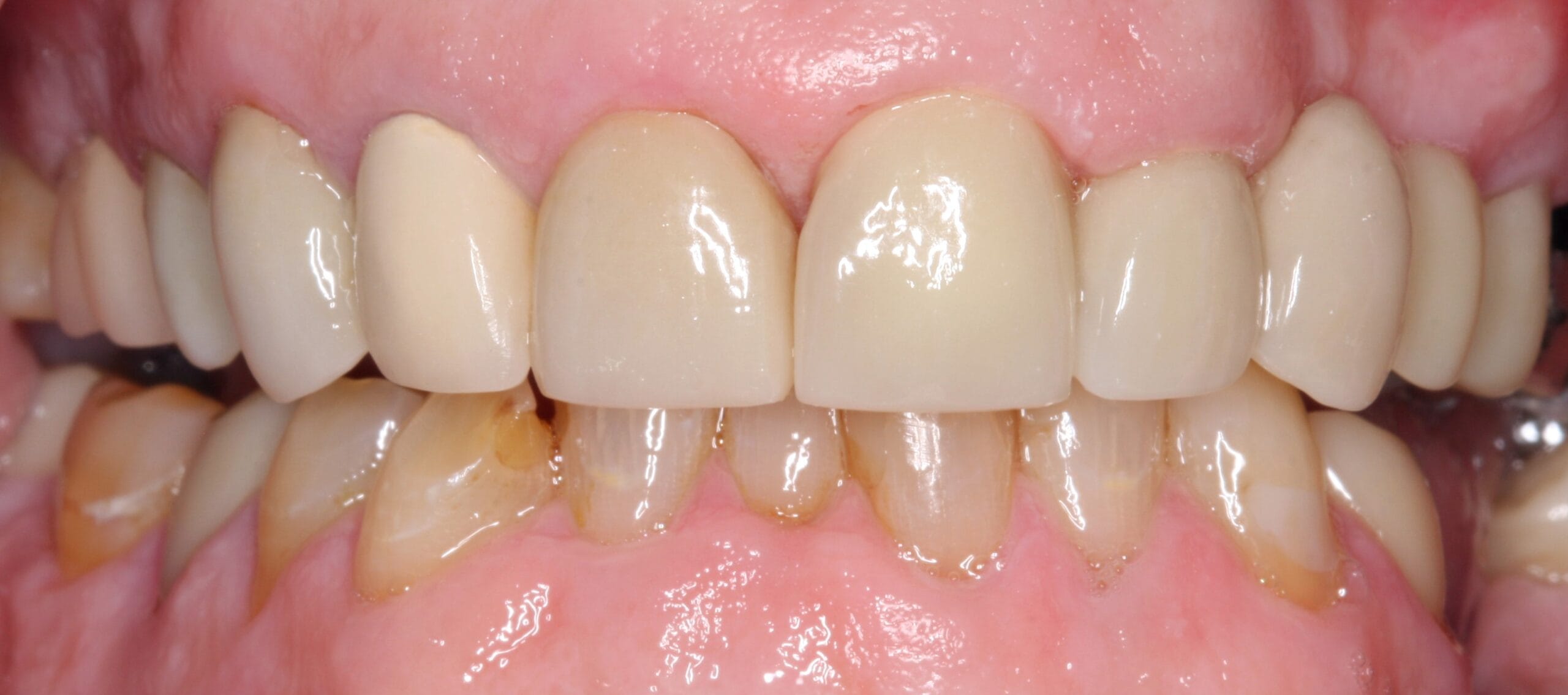Crown patient after smile retracted view.