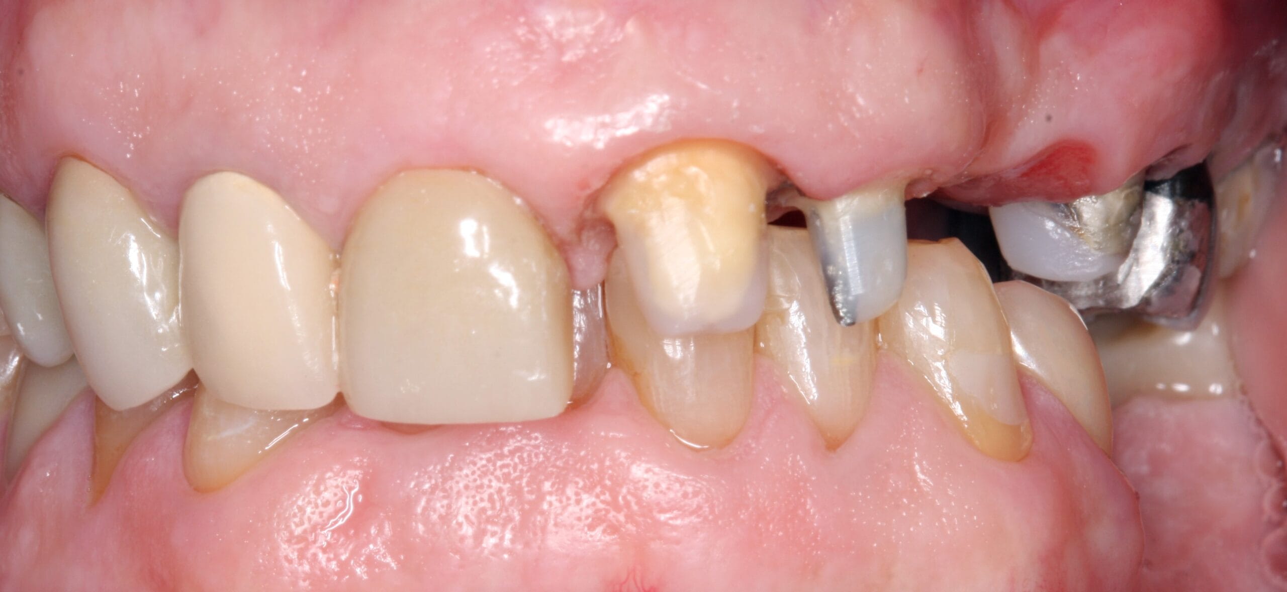 Crown patient before smile retracted view.