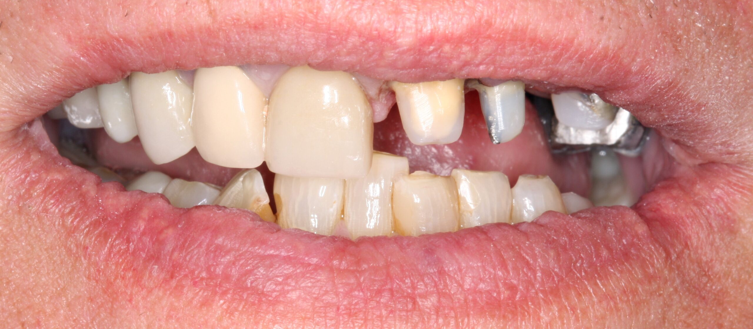 Crown patient before smile.