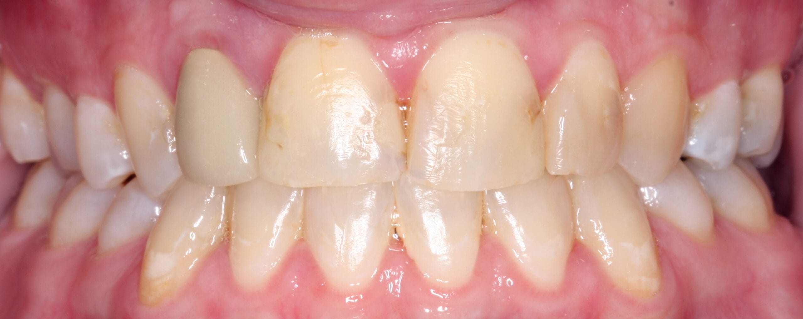 Retracted view of before smile for dental crown patient.