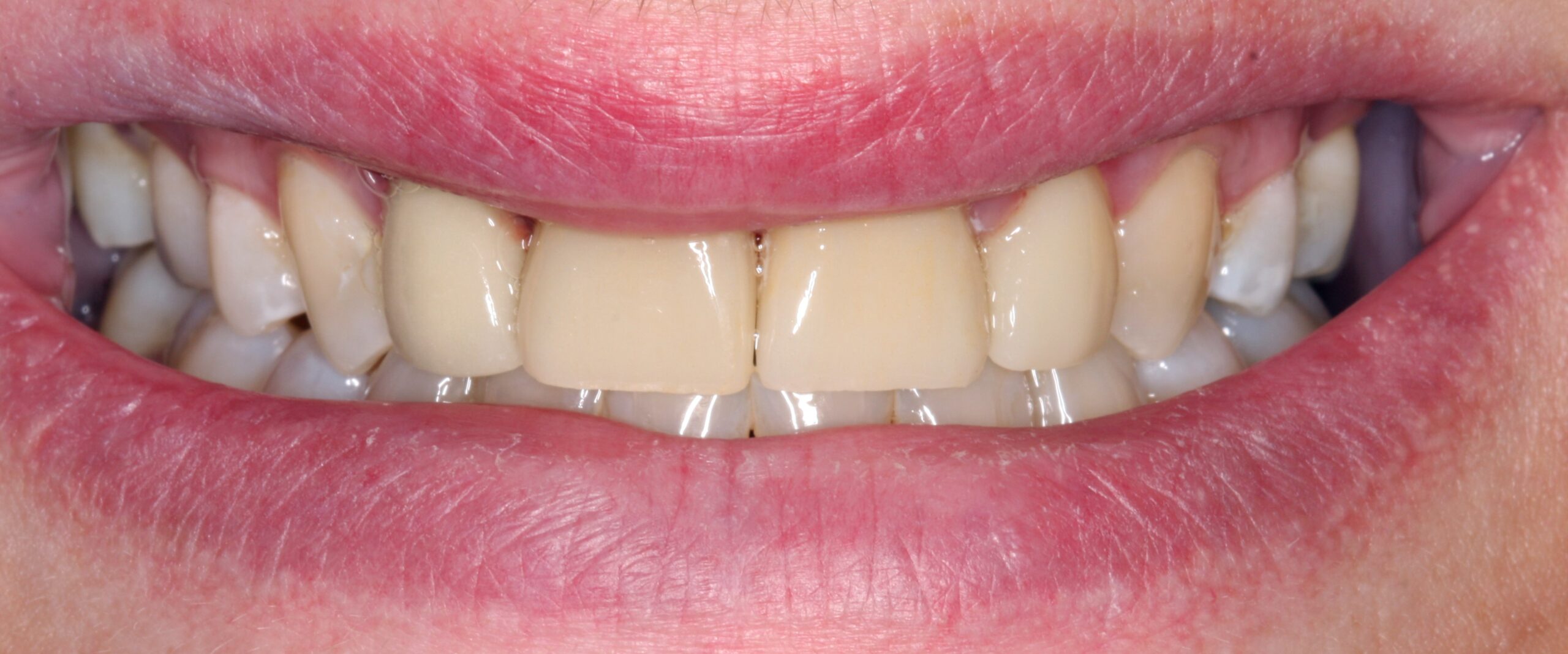 After smile of dental crown patient.