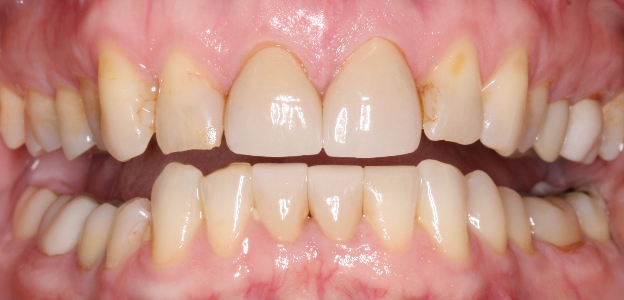 After retracted smile.