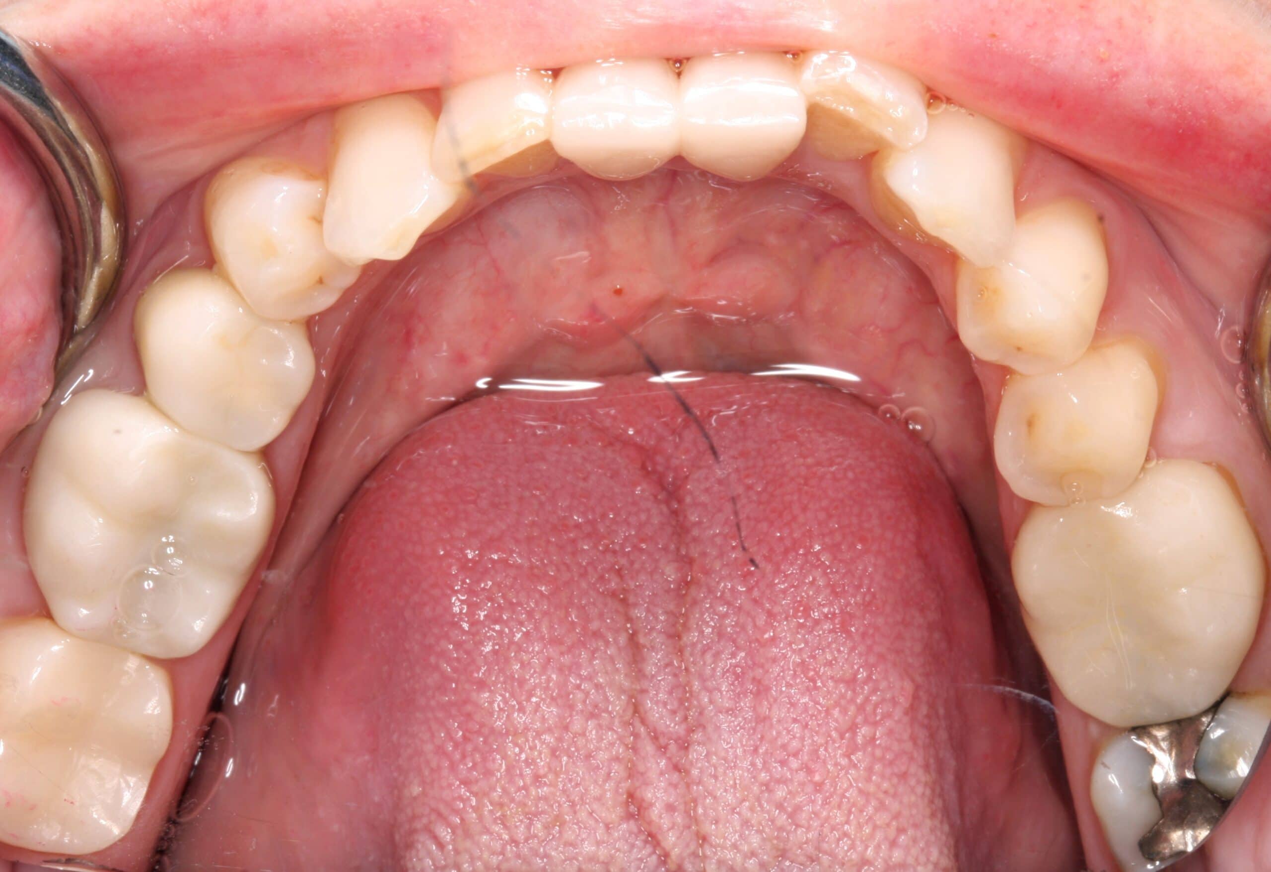 Roof of mouth showing before view of teeth.