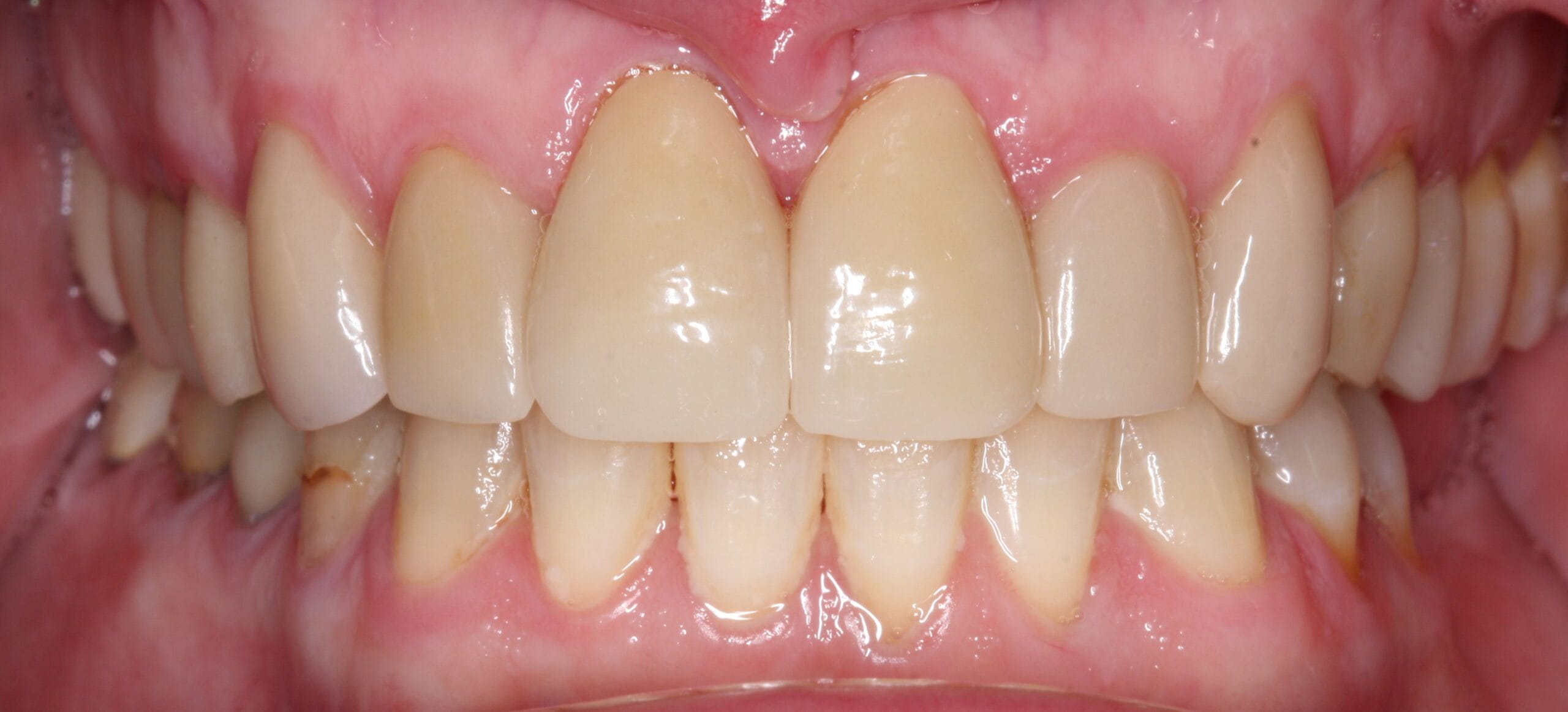 Retracted smile for after the patient had dental crown treatment.