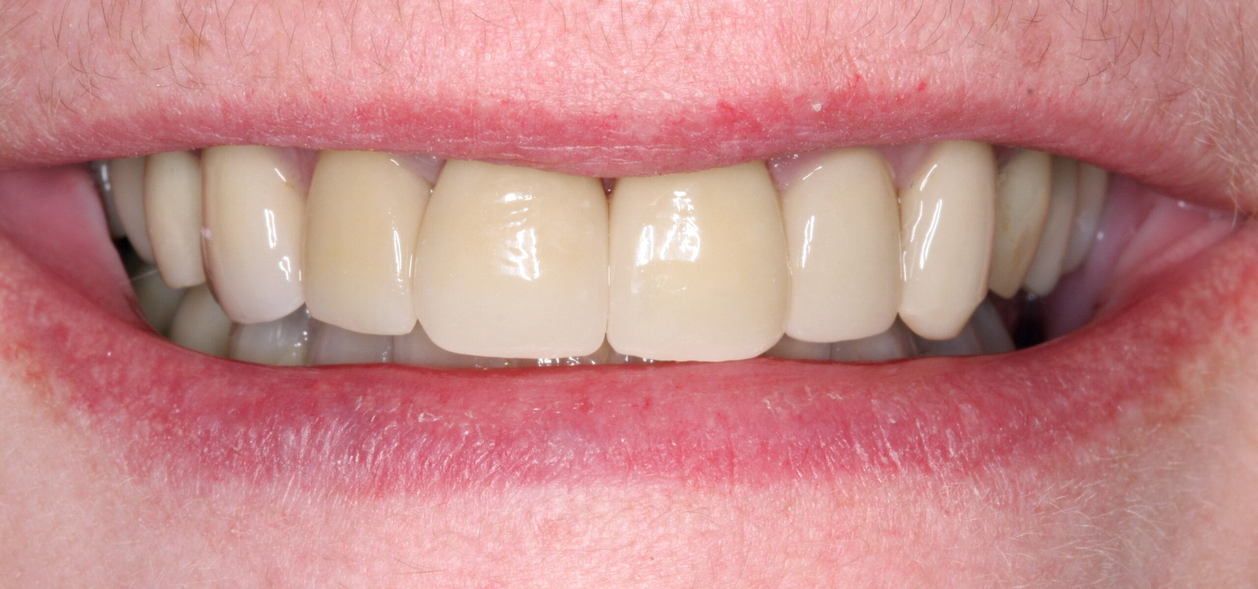 After smile of dental crown treatment.