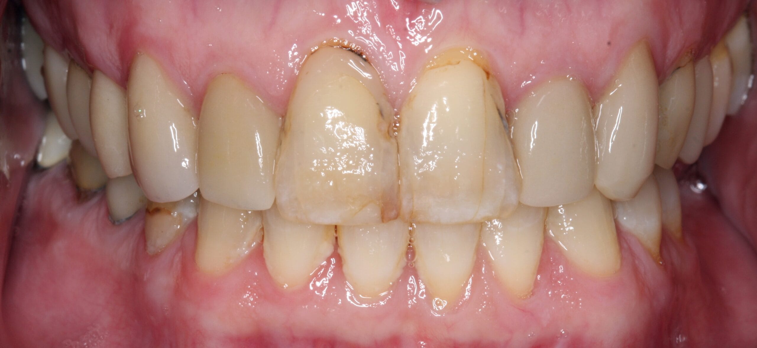 Before retracted smile of patient before dental crown treatment.