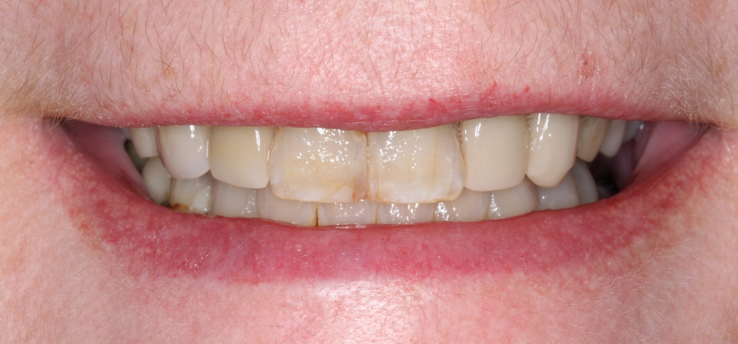 Smile before patient had dental crown treatment.