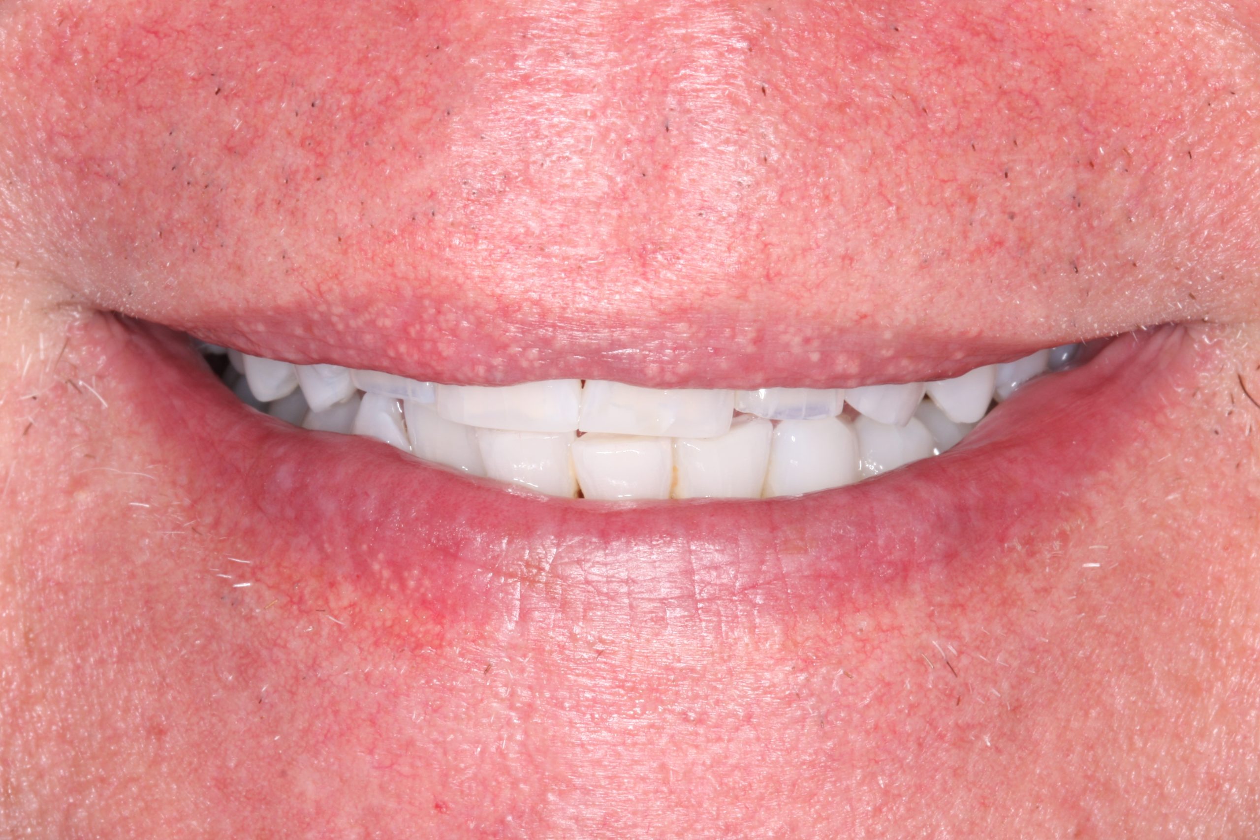 After Smile