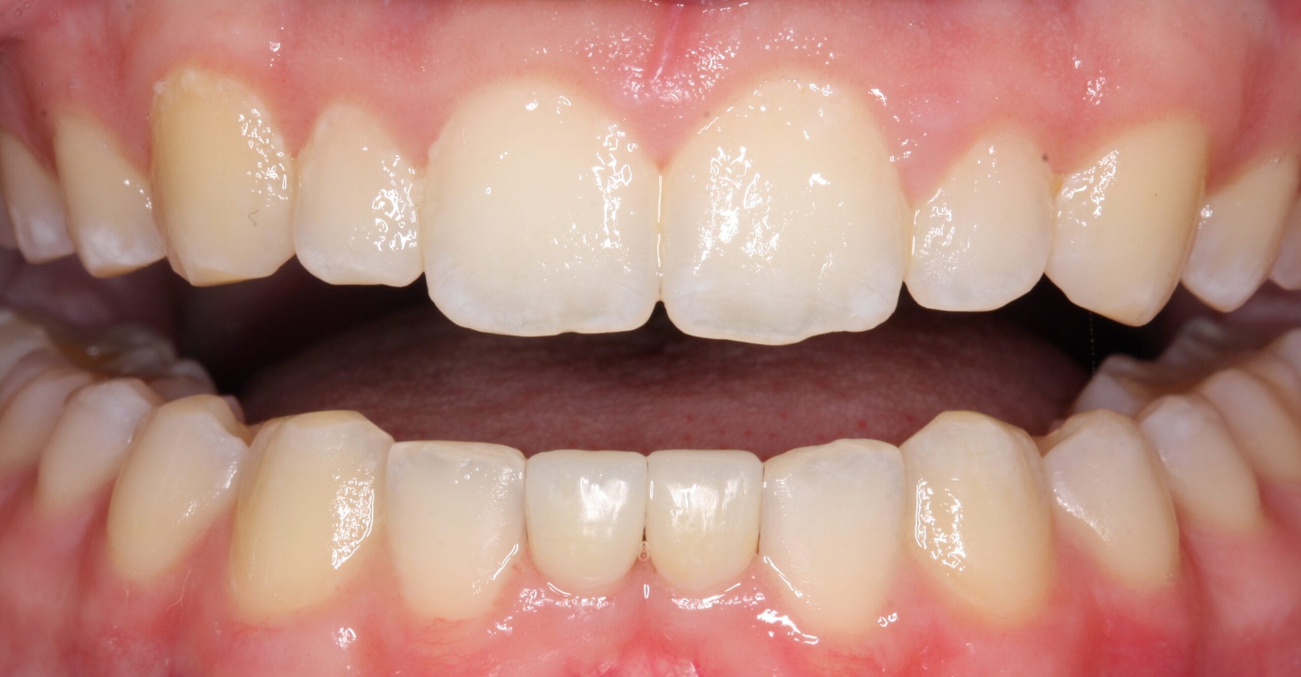 Retracted smile for after the patient had dental crown treatment.