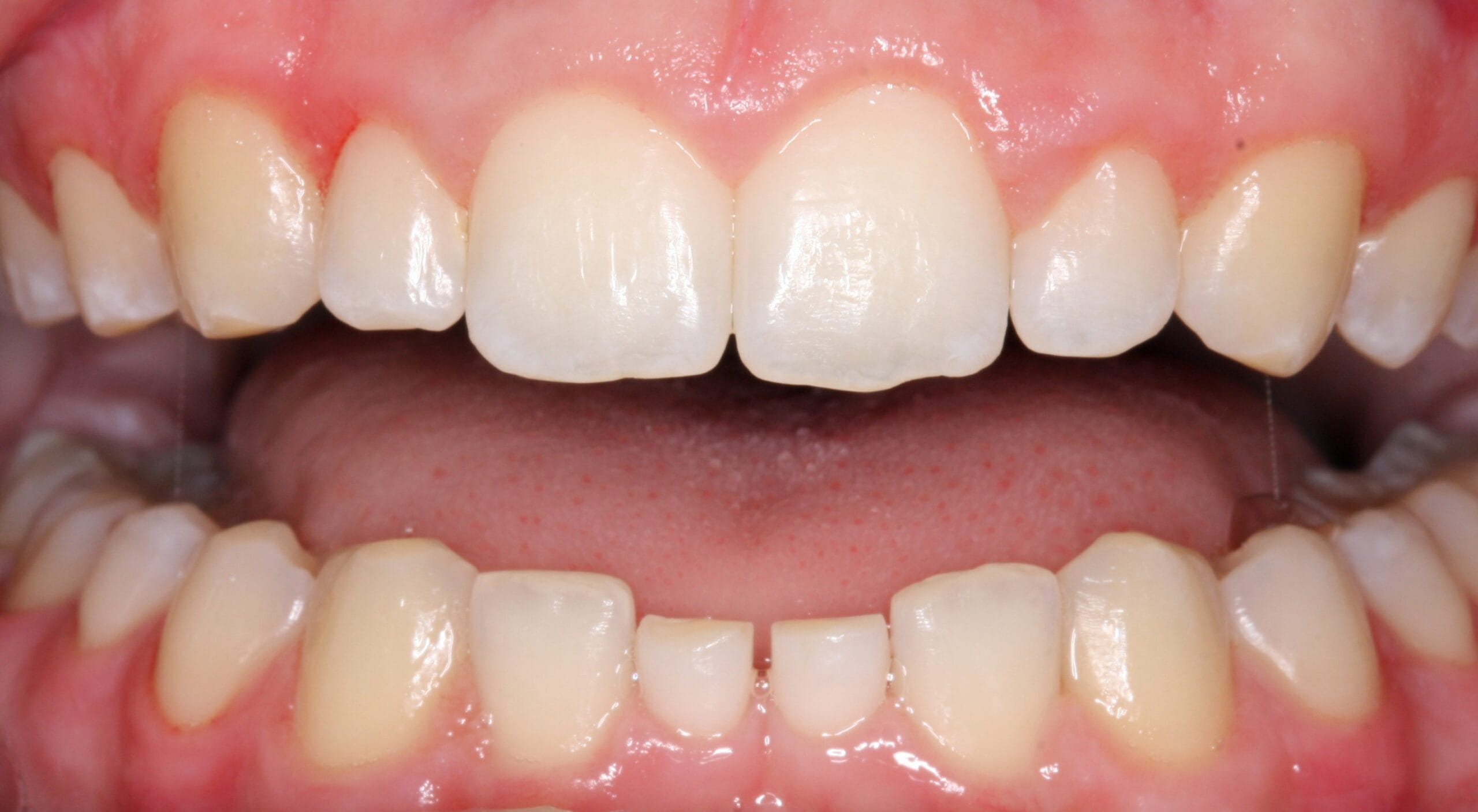 Before retracted smile of patient before dental crown treatment.