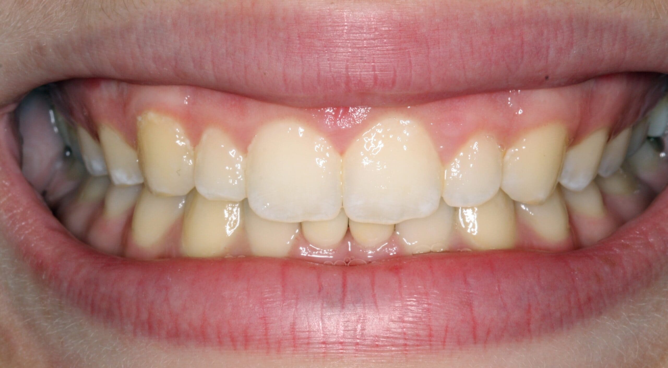 After smile of dental crown treatment.