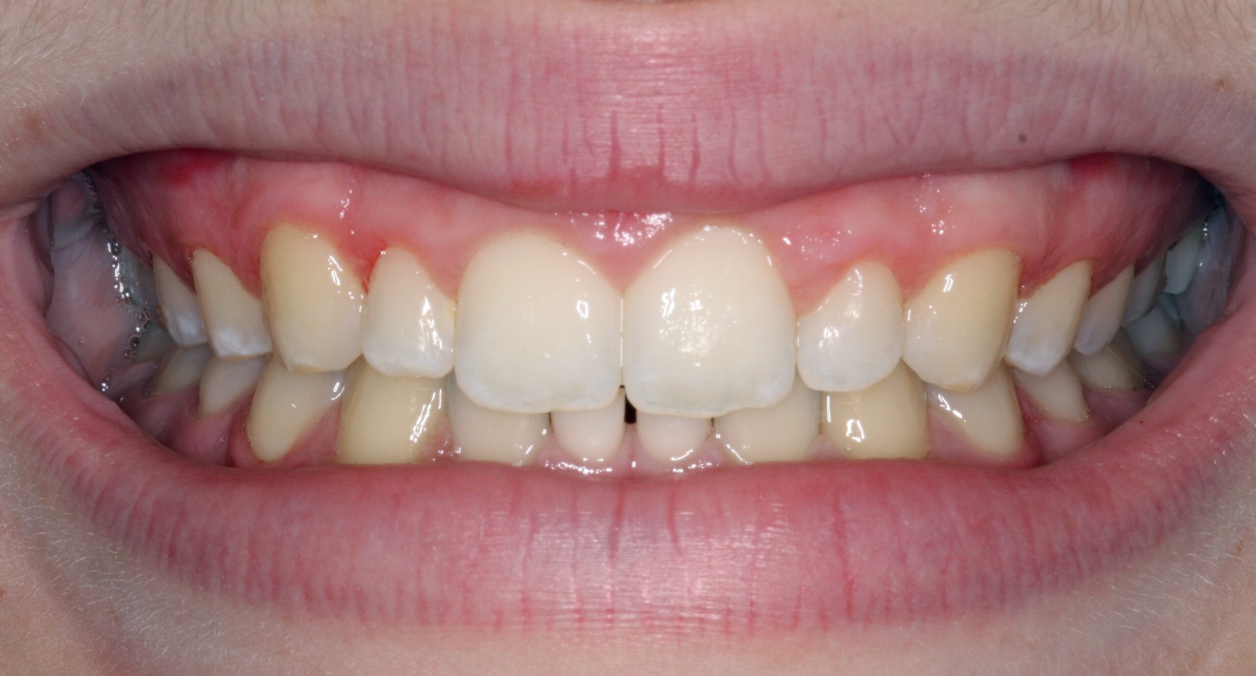 Smile before patient had dental crown treatment.