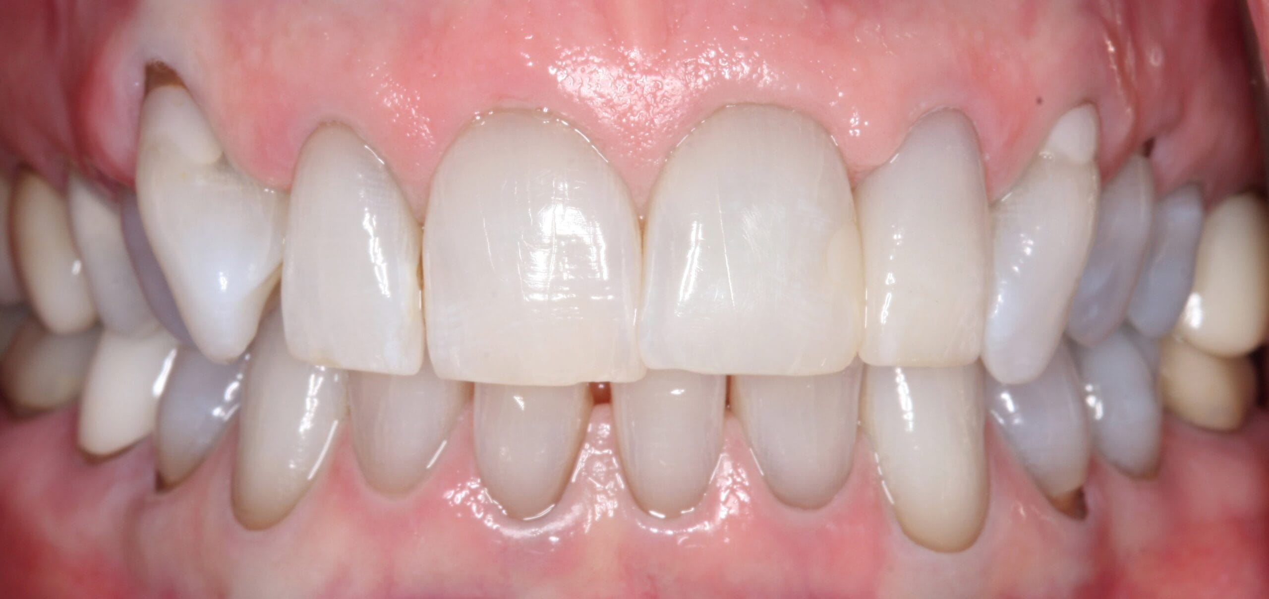 Retracted smile for after the patient had dental crown treatment.