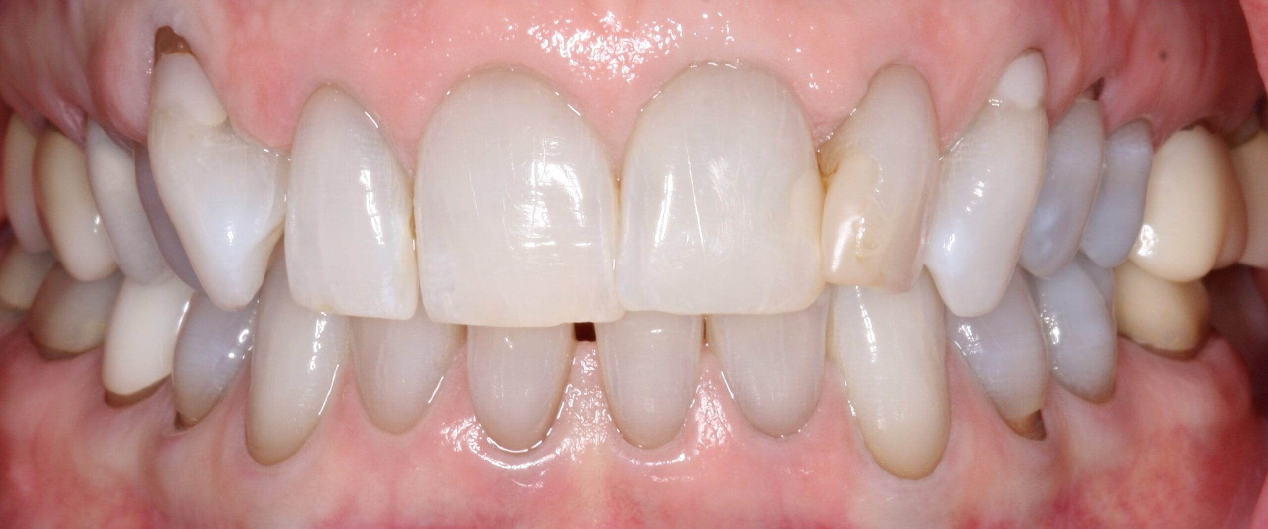 Before retracted smile of patient before dental crown treatment.
