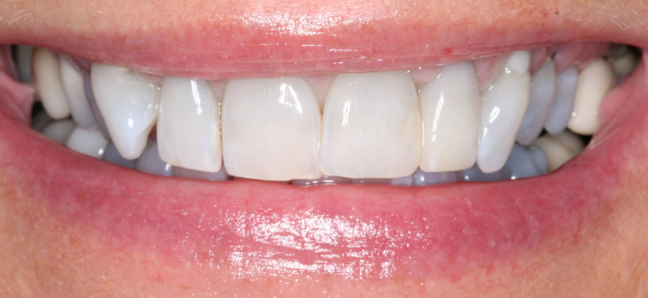After smile of dental crown treatment.