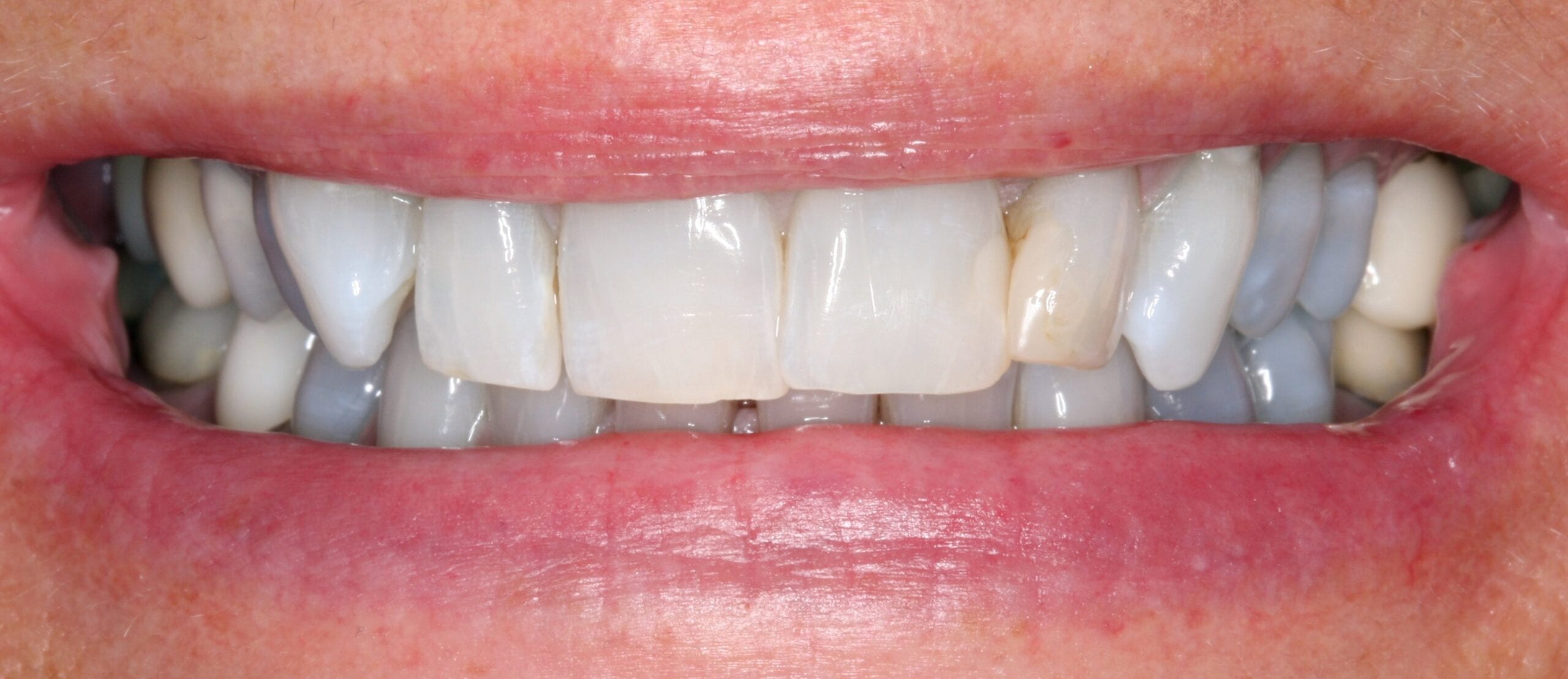 Smile before patient had dental crown treatment.