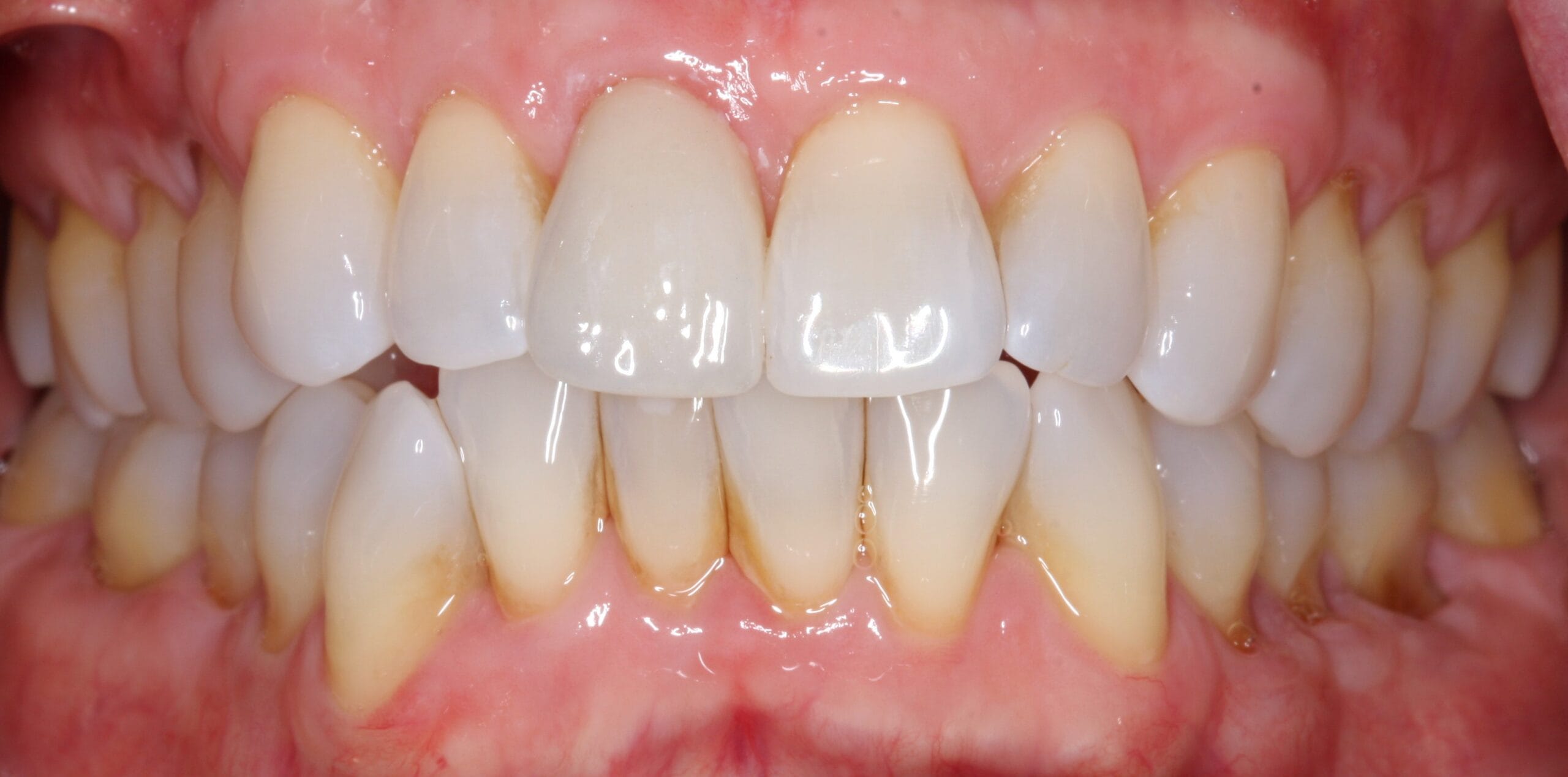 Retracted smile for after the patient had dental crown treatment.