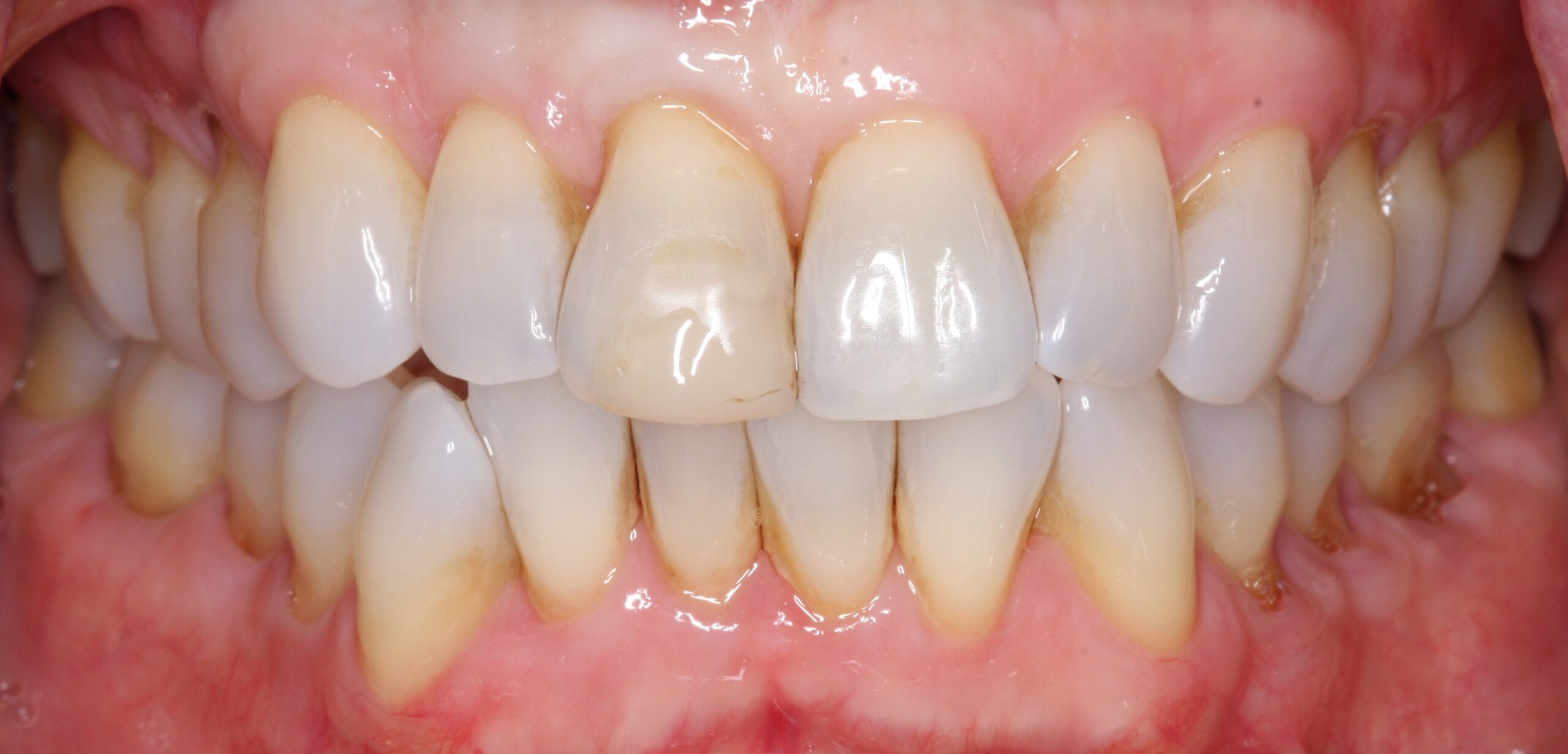 Before retracted smile of patient before dental crown treatment.
