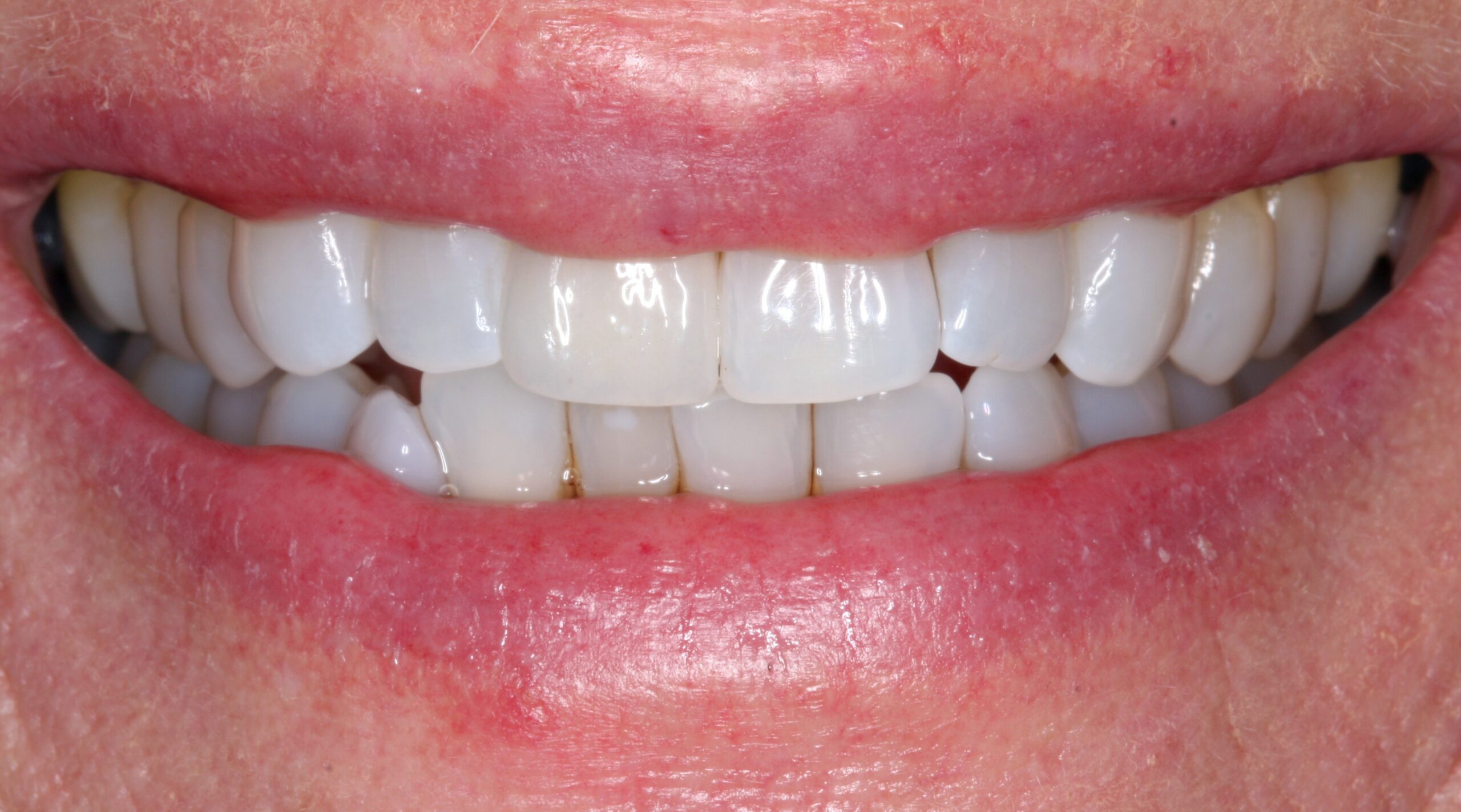 After smile of dental crown treatment.
