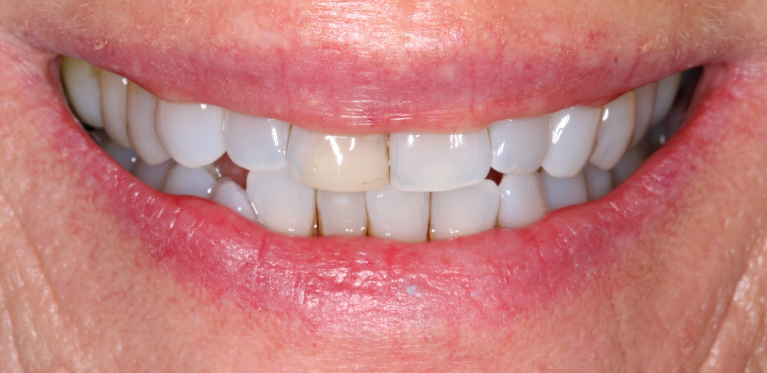 Smile before patient had dental crown treatment.