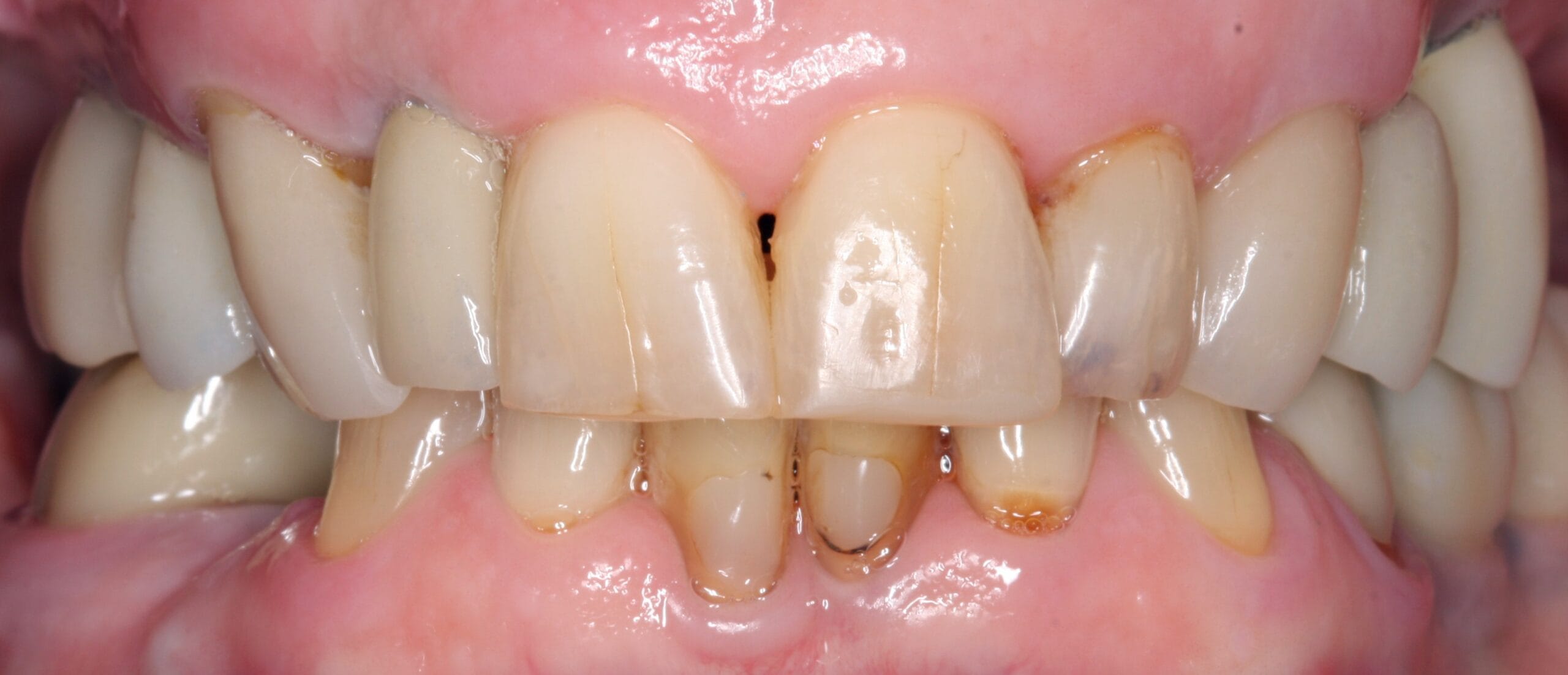 After retracted