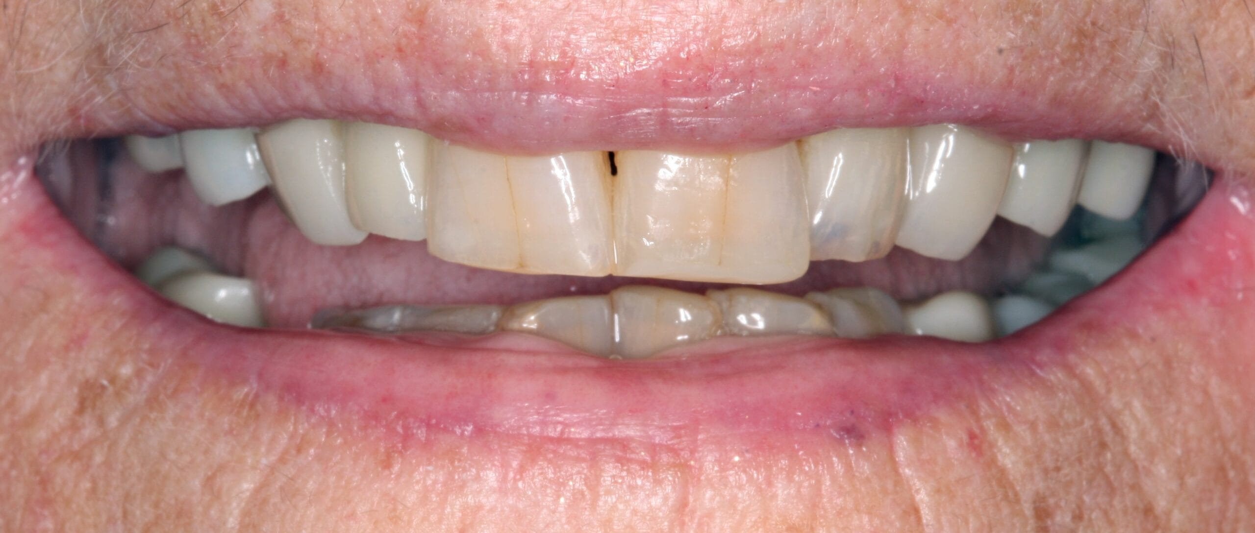 After smile