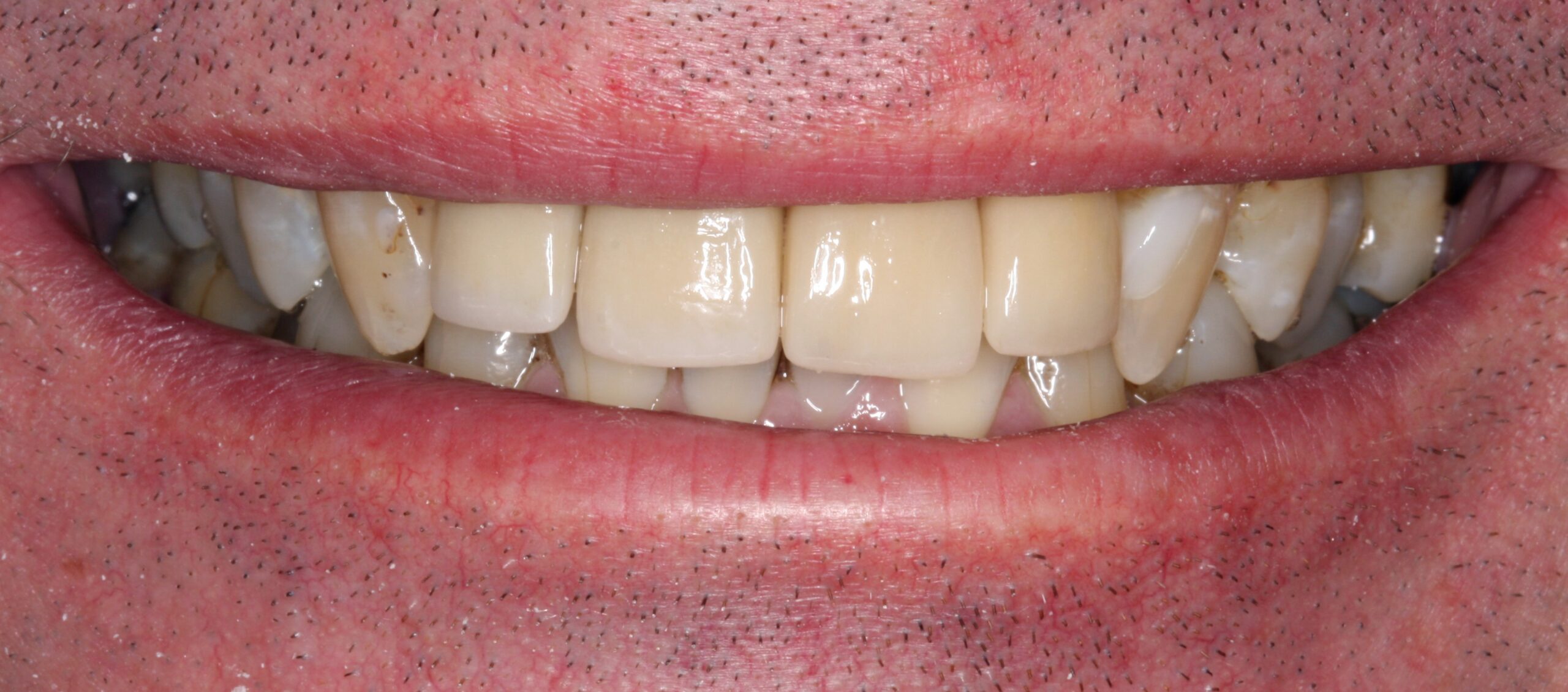After smile of dental crown treatment. 
