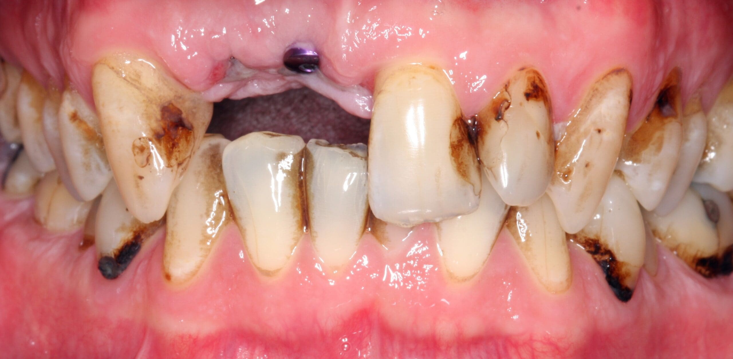 Before retracted smile of patient before dental crown treatment. 