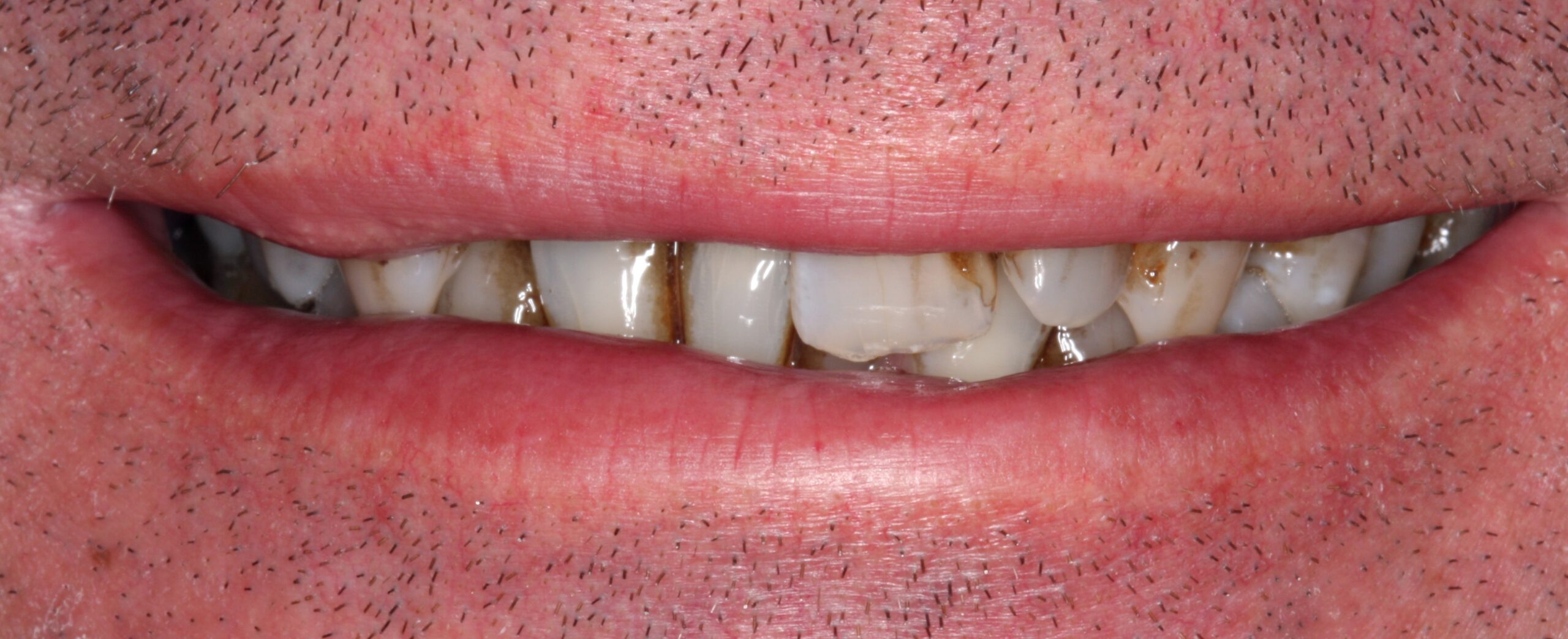 Smile before patient had dental crown treatment. 